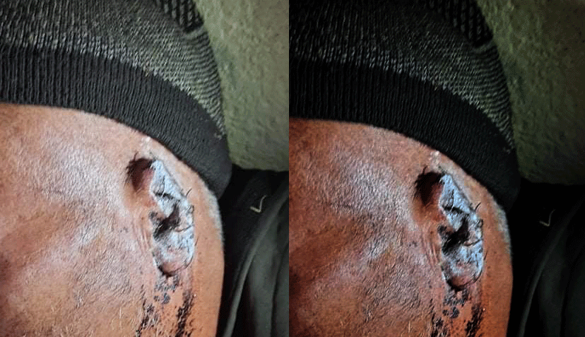 सल्यानमा झगडा गर्दा देब्रे कान भतिजले खाइदिए